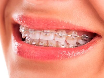 Tratamiento de ortodoncia 