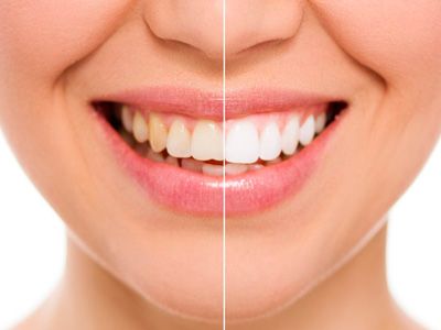 Blanqueamiento dental