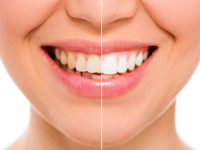 Blanqueamiento dental